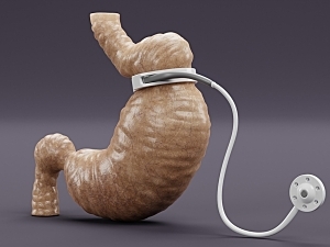 3D rendering of stomach with a gastric band